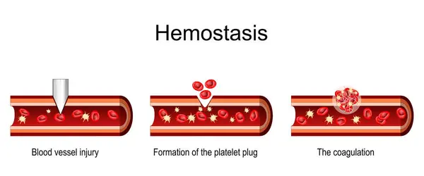Hemosztázis Vérerek Keresztmetszete Sérülés Után Vérlemezke Dugó Kialakulása Véralvadása Sebgyógyulása Stock Illusztrációk