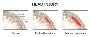 Epidural hematom ve subdural hematom. Travmatik beyin hasarı. İnsan kafatasının enine kesiti. Beyin Meninges 'inin yakın çekimi. Piya maddesi, Dura maddesi, Araknoid ve Kemik. Vektör illüstrasyonu