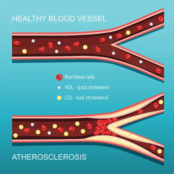 Атеросклероз Рівень Холестерину Перетин Артерії Червоними Кров Яними Тільцями Глл Векторна Графіка