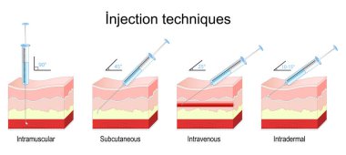Enjeksiyon yöntemleri. Şırıngayla insan derisinin çapraz kesimi. İğne sokma açıları kas içi, deri altı, damar içi ve deri içi enjeksiyonlar için. Vektör illüstrasyonu