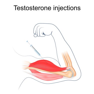 Testosterone injection. Anabolic steroids. Bodybuilding. Muscle enhancement. Human Biceps. Vector illustration clipart