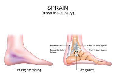 Burkulma. İnsan ayağında yumuşak doku hasarı. Bacak derisinde morarma ve şişlik var. Achilles tendonu, ayak kemikleri ve bağları yakın plan. Calcaneofibular bağ kopmuş. Vektör illüstrasyonu