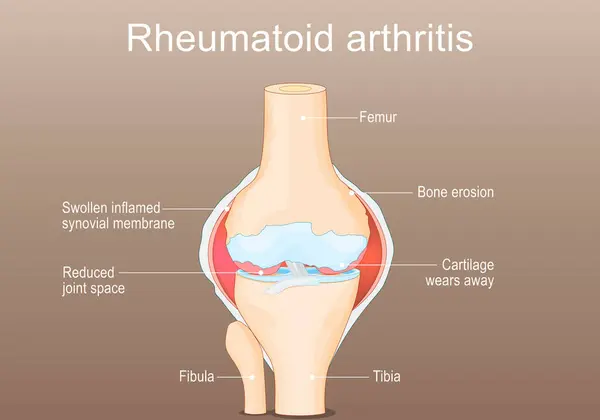 Rheumatoid Arthritis Gyulladásos Típusú Ízületi Gyulladás Amely Érinti Térd Autoimmun Jogdíjmentes Stock Vektorok