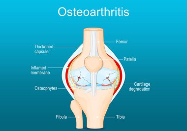 Osteoarthritis. Arthritis of a knee joint. Pain within a knee. Degenerative joint disease. Isometric Flat vector illustration clipart