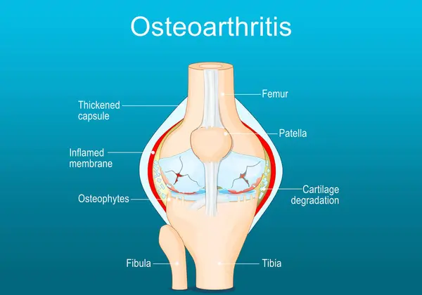 オスチュアート症候群 膝関節の関節炎について 膝の中の痛み 変性関節疾患について イソメトリックフラットベクトルイラスト — ストックベクタ