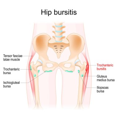 Kalça iltihabı. Kaslar, sinoviyal burslar ve insan kalçasının kemikleri. Trochanteric bursitis. Gerçekçi vektör illüstrasyonu