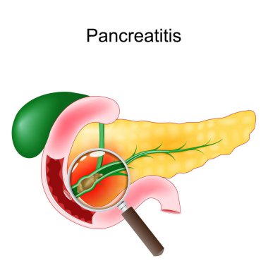 Akut pankreas iltihabı. Gerçekçi bir pankreas, duodenum ve safra kesesi. Büyüteçle safra kesesi taşı görünümlü pankreas kanalının çapraz kesimi. vektör illüstrasyonu