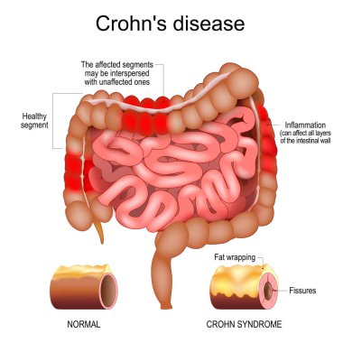 Crohn disease. Human large and small intestine with Healthy segments and Inflammation that affect  layers of the intestinal wall. The affected segments interspersed with unaffected ones. Close-up of a cross section of a intestinal wall with Fat wrapp clipart