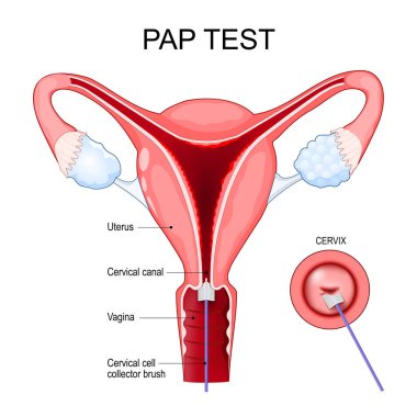 Pap test procedure. Papanicolaou test for Cervical cancer screening. Cross section of a human uterus. Close-up of a Cervix with Cervical cell collector brushand. Pap smear for Cervical cytology.  clipart