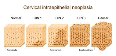 Servikal displazi. Servikal İntraepitel Neoplazya 'dan etkilenen epitelyumun üzerini kaplayan farklılık. Epitelyumun enine kesiti. Normal Squamous hücresi ve anormal hücrelerine yakın çekim. Rahim kanseri evrimi. Vektör illüstrasyonu