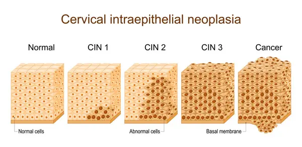 Displasia Cervical Diferença Cobertura Epitélio Afetado Pela Neoplasia Intraepitelial Cervical Ilustração De Stock