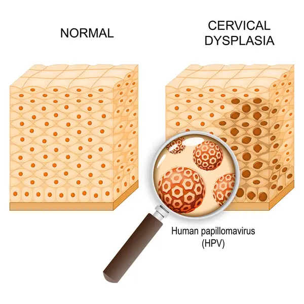 Displasia Cervicale Sezione Trasversale Epitelio Normale Neoplasia Intraepiteliale Cervicale Che Illustrazione Stock