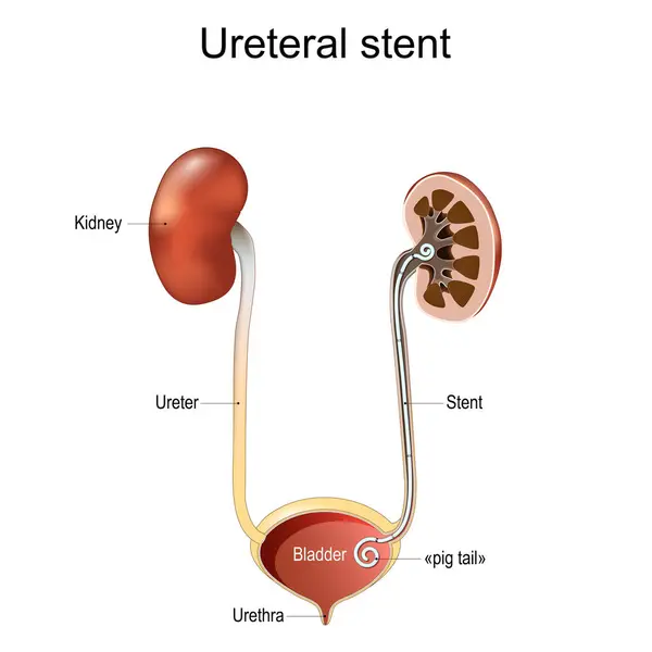 尿道支架 肾绞痛 人类排尿系统 用猪尾支架横切肾和膀胱 在白色背景上孤立的向量图 图库插图