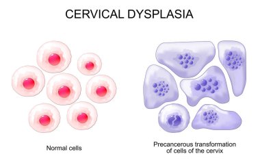 Servikal displazi. Normal Squamous epitelyal hücrelerine yakın çekim ve rahim boynundaki hücrelerin Atipik Precancerous dönüşümü. Rahim ağzı kanseri. Servikal intraepitel neoplazi. CIN 'in sitolojisi. HPV enfeksiyonu. Vektör illüstrasyonu hangi noktada izole edildi