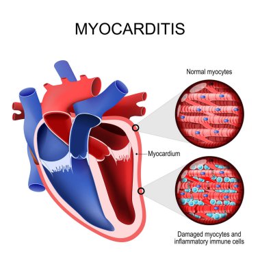Miyokardit. İltihaplı kardiyomiyopati. İnsan kalbi ve miyokardiyumun kesiti. Normal miyoitler, hasarlı miyoitler ve iltihaplı bağışıklık hücreleri. Kalp kaslarının iltihaplanması sonucu kardiyomiyopati kazanmış. Vektör illüstrati