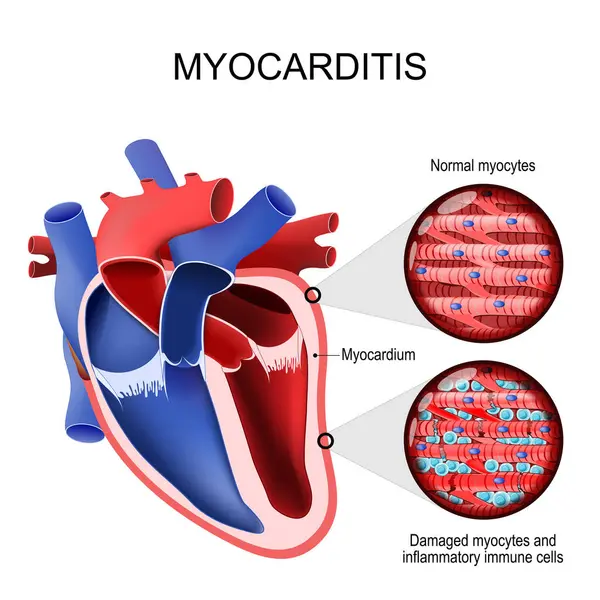 Μυοκαρδίτιδα Φλεγμονώδης Μυοκαρδιοπάθεια Διασταύρωση Ανθρώπινης Καρδιάς Και Μυοκάρδιου Κοντινό Πλάνο Royalty Free Διανύσματα Αρχείου