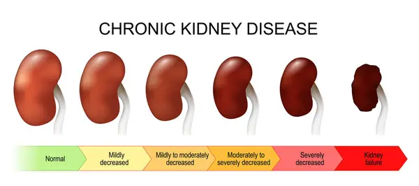 stock vector Chronic kidney disease. Stage of disease from Normal and Mildly decreased, to Kidney failure. Renal dysfunction. GFR test result. vector illustration