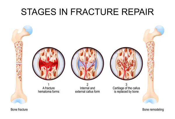stock vector Stages in fracture repair. From Bone fracture and hematoma forms to Cartilage of the callus is replaced by bone and Bone remodeling. Vector illustration