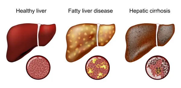 脂肪肝疾患について 肝硬変を起こしました 歴史の閉鎖 正常な肝細胞および脂肪肝および円硬変の細胞の拡大 ベクトルイラスト ロイヤリティフリーストックベクター
