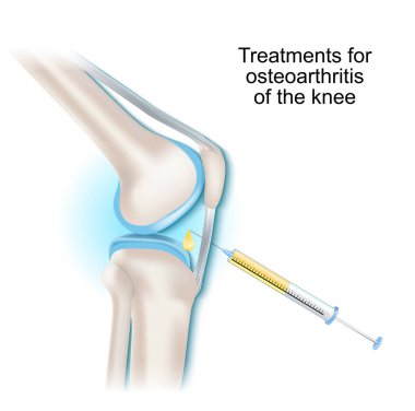 Diz ekleminin osteoartrit tedavisi. Şırınga ve eklem içi enjeksiyon. Vektör illüstrasyonu.