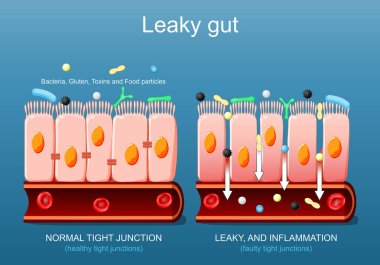 Sızdıran bağırsak. Bağırsak epitelyumunun hücrelerine yakın çekim. Sağlıklı hücreler ve iltihaplı bağırsak hücreleri arasındaki fark. Gastrointestinal bölgede normal doku ve bağırsak geçirgenliğini karşılaştırın. Vektör posteri. Isometric Düz İllüstrasyon.