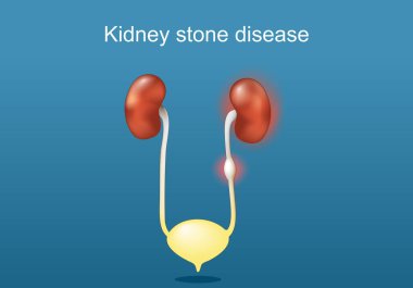 Kidney stone disease. Anatomy human urinary system. Kidneys, ureter with stone, urinary bladder, and urethra. Renal calculi. Vector poster. Isometric Flat illustration. clipart