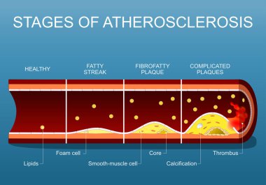 Ateroskleroz aşamaları, kan akışındaki lipidlerden Endothelium 'daki yağ dokusu bozulmasına, Fibrofat plaket oluşumuna, plaka yırtılmasına, kireçlenme ve trombus çıkıntısına kadar. Atardamar duvarına yakın çekim. Kardiyovasküler hastalık. Isometric Fla