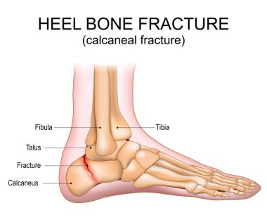 Heel bone fracture. Calcaneal fracture. Foot injury. Vector illustration. clipart