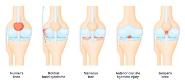 Diz yaralanmaları. İnsan diz ekleminin anatomisi. Ön çapraz bağ zedelenmesi, Jumper 's ve Runner' s dizleri, dizkapağı tendoniti, menisküs yırtığı, ilyotibiyal bant sendromu. Vektör illüstrasyonu.