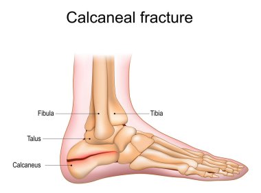 Kalkaneal kırık. Topuk kemiği travması. Ayak yaralanması. Ayak eklemlerinin anatomisi. Vektör illüstrasyonu