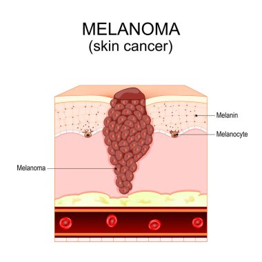 Melanoma. Melanositten kaynaklanan deri kanseri. İnsan derisinin katmanları ve yapısı. Derinin çapraz kesimi. Vektör illüstrasyonu