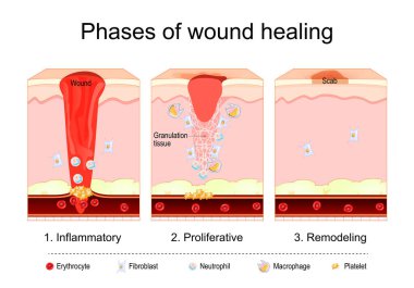 Wound healing process. Tissue repair. Inflammatory, Proliferative, Remodeling phase. Cross section of human skin after trauma. Disruption and damage of tissue and blood vessel. Bleeding. Vector illustration clipart