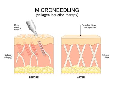 Mikro donanım prosedürü. Kolajen endüksiyon terapisinden önce ve sonra insan derisinin çapraz kesimi. Cilt tazeleme. Yaşlanma karşıtı tedavi. Kırışıklıklar, yaralar, esneme, izler, pigmentasyon için cerrahi müdahale. Deriyi defalarca küçük bir şeyle delmiş., 