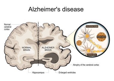 Alzheimer hastalığı. Nörodejenerasyon. Normal ve Alzheimer beyninin enine kesit, serebral korteks, genişlemiş ventrikül ve hipokampüs. Nörofibriller arapsaçı ve amiloid plakları olan nöronlara yakın çekim. Vektör illüstrasyonu