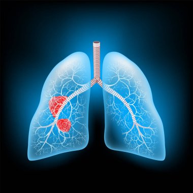 Akciğer kanseri. Tümörlü ve Metastasis 'li gerçekçi şeffaf mavi insan akciğerleri. Karanlık arka planda parlak bir etki. Sağlık hizmetleri tasarımı için X-ray görüntüsü gibi vektör illüstrasyonu. 