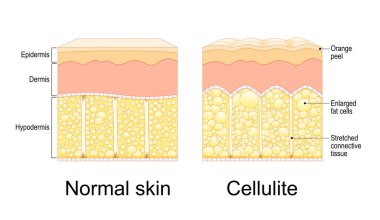 Selülit oluşumu. Portakal kabuğu sendromu. Adiposis ödematosa. Selülit ve sağlıklı cildin kesiti. Deri anatomisi. İnsan vücudunun yağ dokusu. Vektör çizimi. Epidermis ve cilt dokusu. 