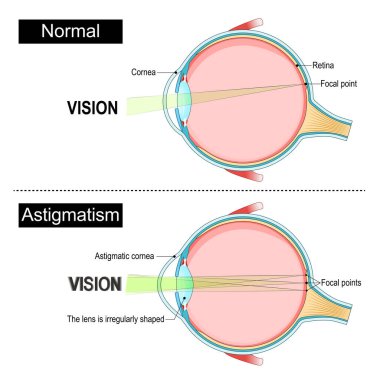 Astigmatizm. Göz anatomisi. Mercek, kornea ve Retina üzerindeki odak noktaları normal ve astigmatik gözde. İnsan gözünün çapraz kesiti. Eğitim ve tıbbi kullanım diyagramı. Vektör illüstrasyonu