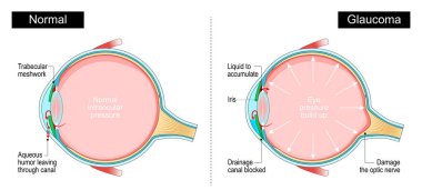Glaukoma. İnsan gözünün çapraz kesiti. İntraoküler basınç. Görüş kaybı. Göz anatomisi. Eğitim ve tıbbi kullanım diyagramı. Vektör illüstrasyonu
