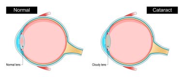 Katarakt. Normal lens ve bulutlu mercekle insan gözünün çapraz kesiti. Bulanık görme. Göz sağlığı. Gözdeki yaşlanma süreci. Görüş azalıyor. Vektör posteri