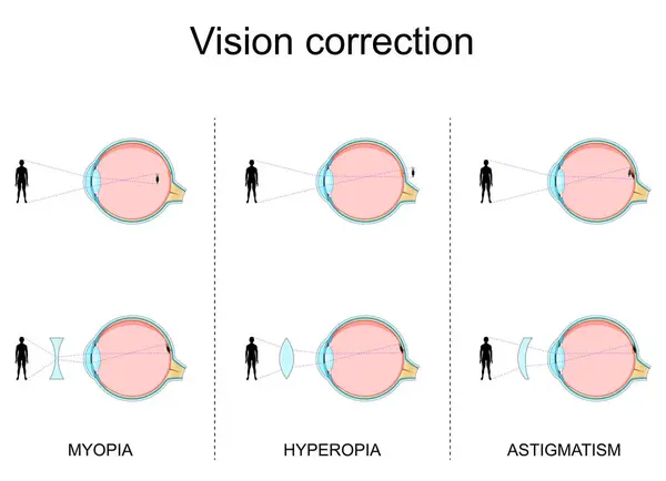 stock vector Vision defects. Myopia, Hyperopia, Astigmatism. Vision Correction by glasses. Refractive errors. Cross section of human eye. Close-up of a macula, retina, sclera, and fovea. 