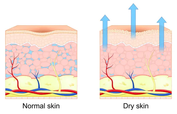 stock vector Dry and normal skin. Cross section of human skin. Loss of moisture in human skin. Vector illustration