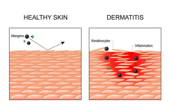 stock vector Dermatitis. Eczema. Psoriasis. Cross section of a human skin. Close-up of Inflammation epidermis. Allergens penetration into skin. Atopic dermatitis. Vector illustration