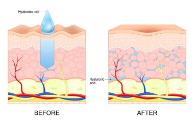 Hyaluronic acid. Skin rejuvenation. Wrinkles Before and after hyaluronic acid use. Vector illustration clipart