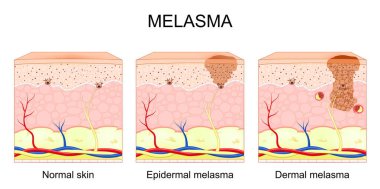 Melasma. Kloasma faciei türleri. İnsan derisinin hiperpigmentasyonla çapraz kesimi. Deri ve epidermal melasyon. Hamilelik maskesi. Vektör illüstrasyonu
