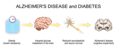 Diyabet ve Alzheimer hastalığının ilerlemesi. Obeziteden, insülin direncinden, bilişsel çöküşe ve Alzheimer 'a kadar. vektör illüstrasyonu 