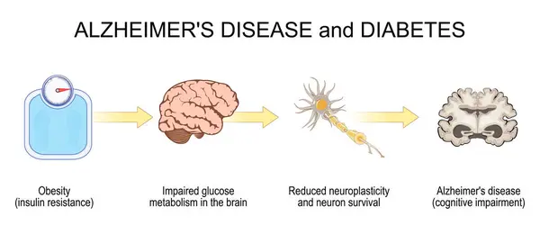 stock vector Diabetes and Alzheimer's disease progression. From Obesity, Insulin resistance, to Cognitive Decline and Alzheimer. vector illustration 