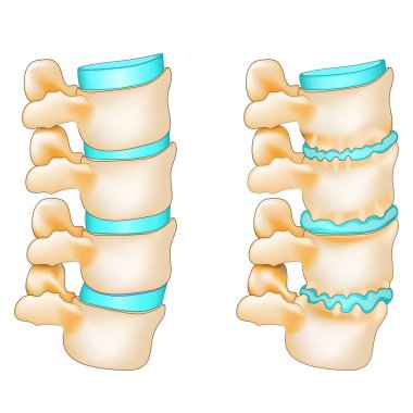 Osteofit formasyonu ve normal omurgası olan dejeneratif disk. Kemik mahmuzları ve disk fıtığı olan yaşlı bir omurga. Omurilik iltihabı. Vektör illüstrasyonu
