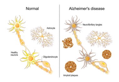 Alzheimer's disease. Comparison of neurons in a healthy brain and nerve cells in neurodegenerative disease. Dementia. Close-up of neurons with Neurofibrillary tangles and Amyloid plaques. Vector illustration clipart