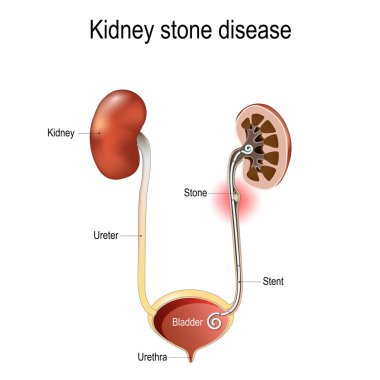 Böbrek taşı hastalığı. Ureter 'in Taş ve Stent' le kesişen bölümü. Böbrek hesabı. İnsan idrar sisteminin anatomisi böbrekler, üreterler, idrar kesesi ve üretrayı içerir. Vektör illüstrasyonu