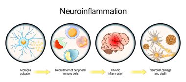 Neuroinflammation. Development of neurodegenerative diseases from Microglia activation and Recruitment of peripheral immune cells to brain chronic inflammation, Neuronal damage and death. Vector illustration clipart